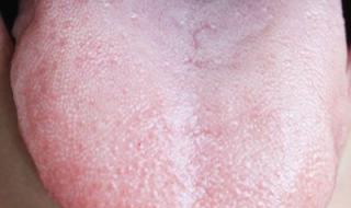 阳后舌头长厚白舌苔